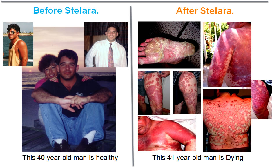 Stelara Side Effects, Stelara-Side-Effects, Clinical Trials, Stelara Adverse Event, Ustekinumab